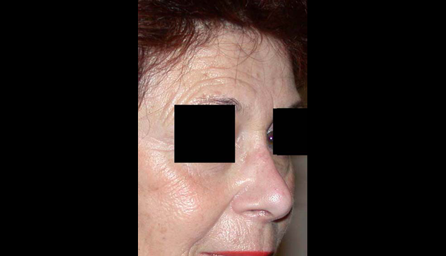 chirurgie-esthetique-interventions-nez-rhinoplasties