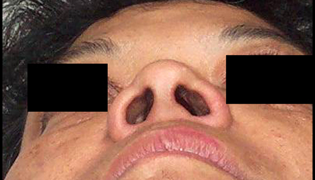 chirurgie-esthetique-interventions-nez-rhinoplasties