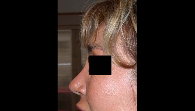 chirurgie-esthetique-interventions-nez-rhinoplasties