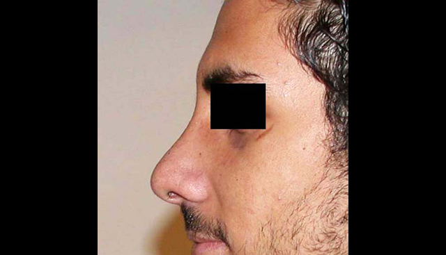 chirurgie-esthetique-interventions-nez-rhinoplasties
