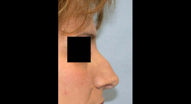 chirurgie-esthetique-interventions-nez-rhinoplasties