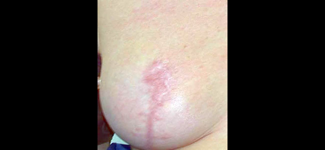 chirurgie-esthetique-interventions-chirurgie-secondaire-seins