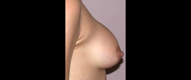 chirurgie-esthetique-interventions-chirurgie-secondaire-seins