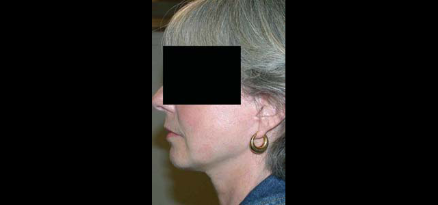 chirurgie-esthetique-interventions-visage-liftings