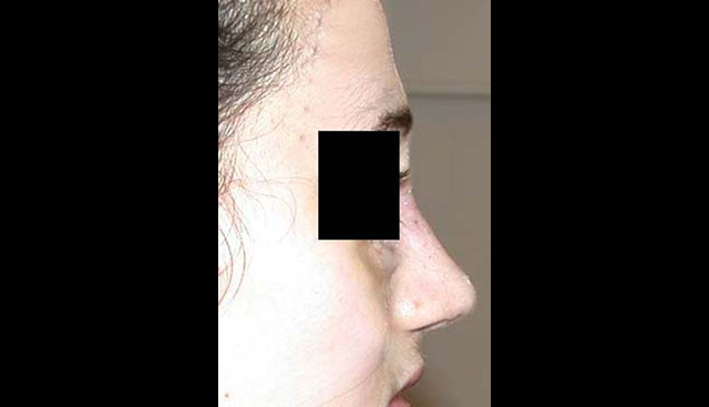 chirurgie-esthetique-interventions-nez-rhinoplasties
