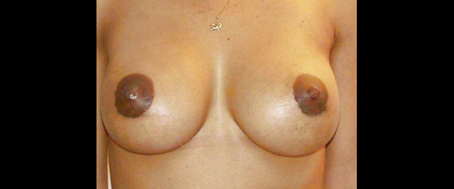 chirurgie-esthetique-interventions-chirurgie-secondaire-seins