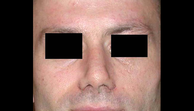 chirurgie-esthetique-interventions-nez-rhinoplasties