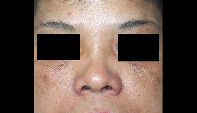 chirurgie-esthetique-interventions-nez-rhinoplasties