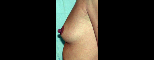 chirurgie-esthetique-interventions-seins-augmentations-mammaires