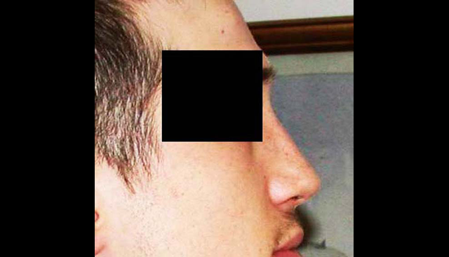 chirurgie-esthetique-interventions-nez-rhinoplasties