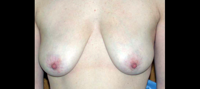chirurgie-esthetique-interventions-seins-ptoses-mammaires-sans-implant